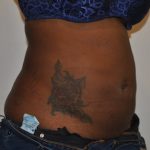 Liposuction Before & After Patient #2560