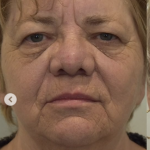 Blepharoplasty Before & After Patient #2252