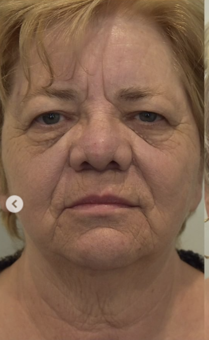 Blepharoplasty Before & After Patient #2252