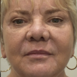 Blepharoplasty Before & After Patient #2252