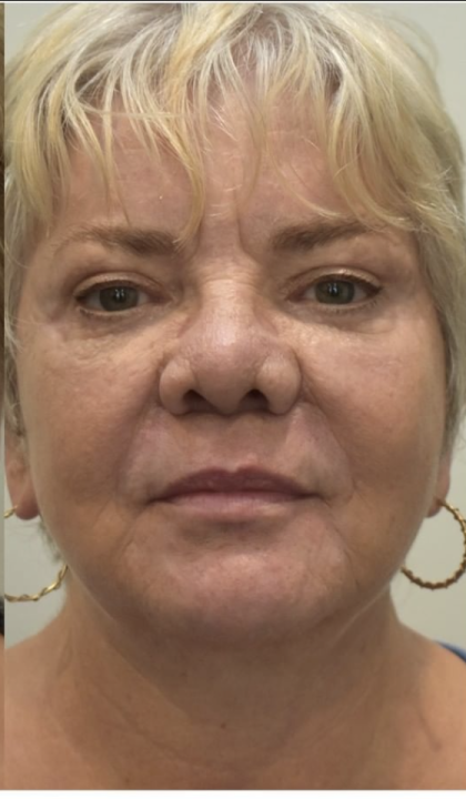 Blepharoplasty Before & After Patient #2252