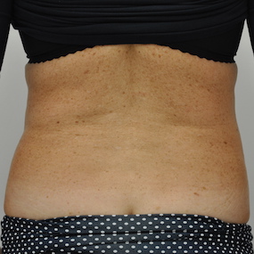 Liposuction Before & After Patient #2561