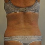 Liposuction Before & After Patient #2561