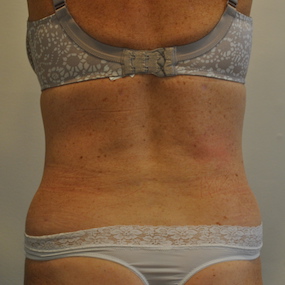 Liposuction Before & After Patient #2561