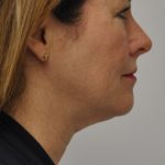 Liposuction Before & After Patient #2556