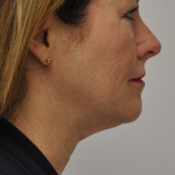 Liposuction Before & After Patient #2556