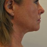 Liposuction Before & After Patient #2556