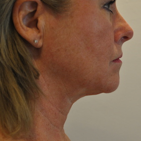 Liposuction Before & After Patient #2556
