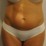 Liposuction Before & After Patient #2563