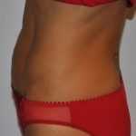Liposuction Before & After Patient #2563