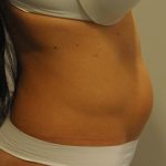 Liposuction Before & After Patient #2563