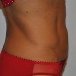 Liposuction Before & After Patient #2563