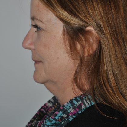 Liposuction Before & After Patient #2564