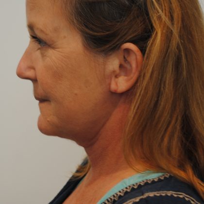 Liposuction Before & After Patient #2564