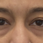 Blepharoplasty Before & After Patient #2253