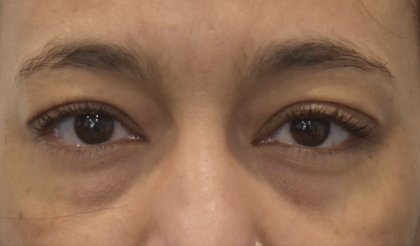 Blepharoplasty Before & After Patient #2253
