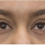 Blepharoplasty Before & After Patient #2253