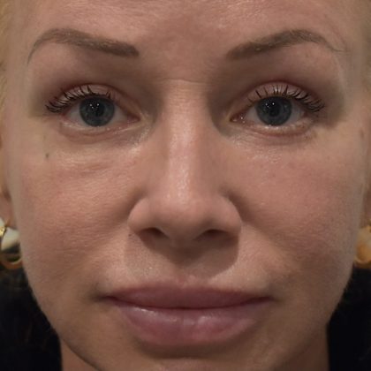 Blepharoplasty Before & After Patient #2255