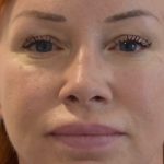 Blepharoplasty Before & After Patient #2255