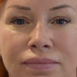 Blepharoplasty Before & After Patient #2255