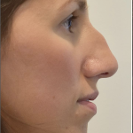 Rhinoplasty Before & After Patient #2248