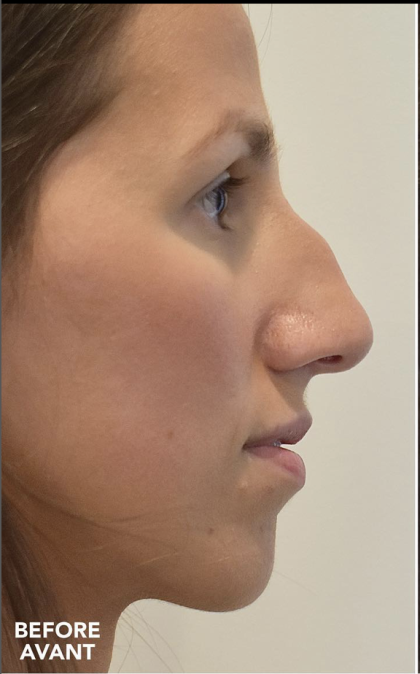 Rhinoplasty Before & After Patient #2248