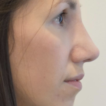Rhinoplasty Before & After Patient #2248