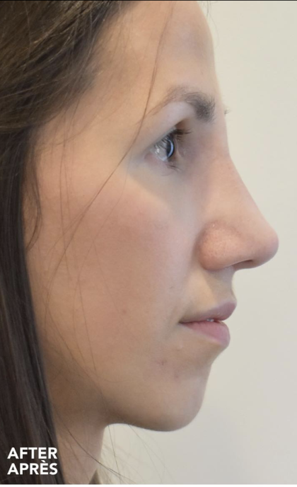 Rhinoplasty Before & After Patient #2248
