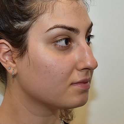 Rhinoplasty Before & After Patient #2249
