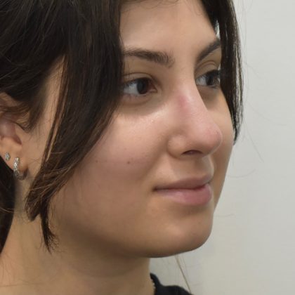 Rhinoplasty Before & After Patient #2249