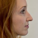 Rhinoplasty Before & After Patient #2250