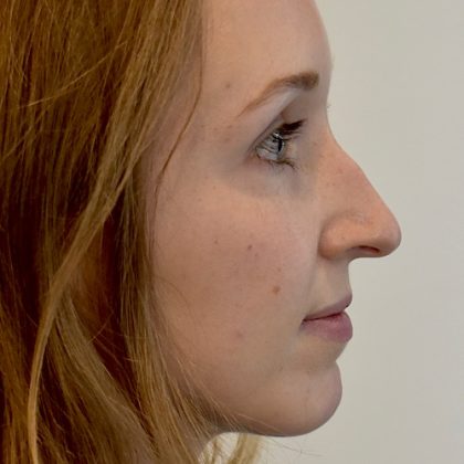 Rhinoplasty Before & After Patient #2250