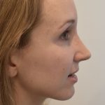 Rhinoplasty Before & After Patient #2250