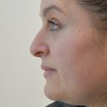 Rhinoplasty Before & After Patient #2251