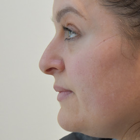 Rhinoplasty Before & After Patient #2251