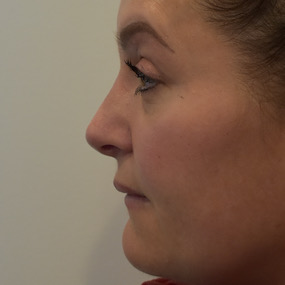 Rhinoplasty Before & After Patient #2251