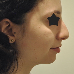 Rhinoplasty Before & After Patient #2232