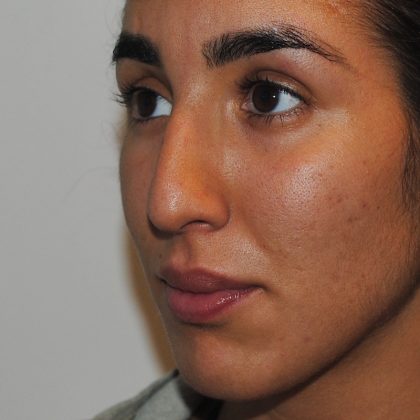 Rhinoplasty Before & After Patient #2234
