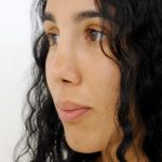Rhinoplasty Before & After Patient #2234