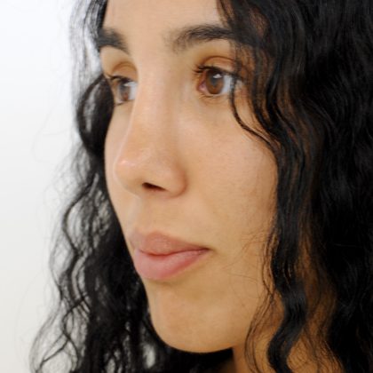 Rhinoplasty Before & After Patient #2234