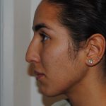 Rhinoplasty Before & After Patient #2234