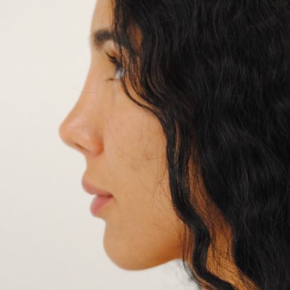Rhinoplasty Before & After Patient #2234