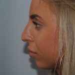 Rhinoplasty Before & After Patient #2235