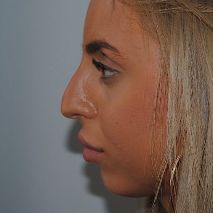 Rhinoplasty Before & After Patient #2235