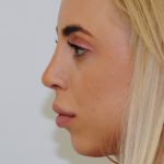 Rhinoplasty Before & After Patient #2235