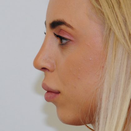 Rhinoplasty Before & After Patient #2235