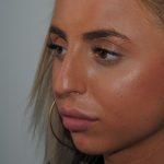 Rhinoplasty Before & After Patient #2235