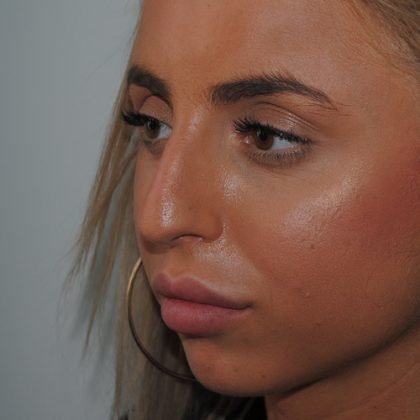 Rhinoplasty Before & After Patient #2235