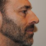 Rhinoplasty Before & After Patient #2237