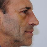 Rhinoplasty Before & After Patient #2237